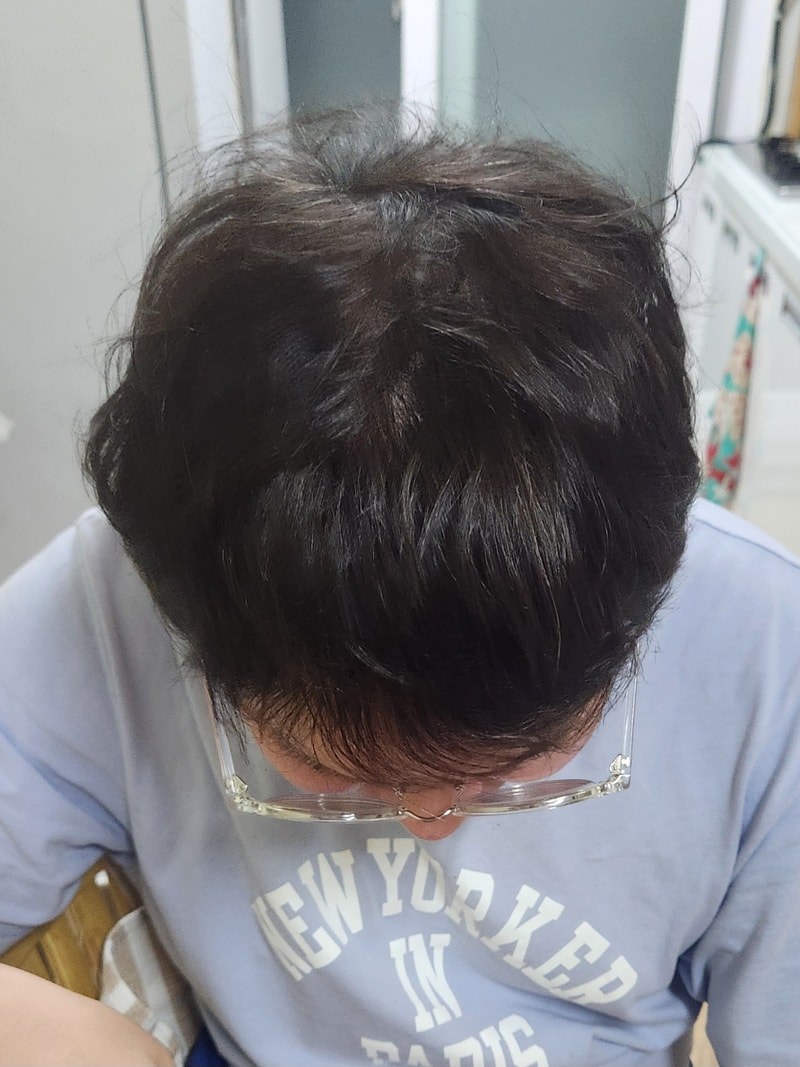 모재성 모발이식 8개월차