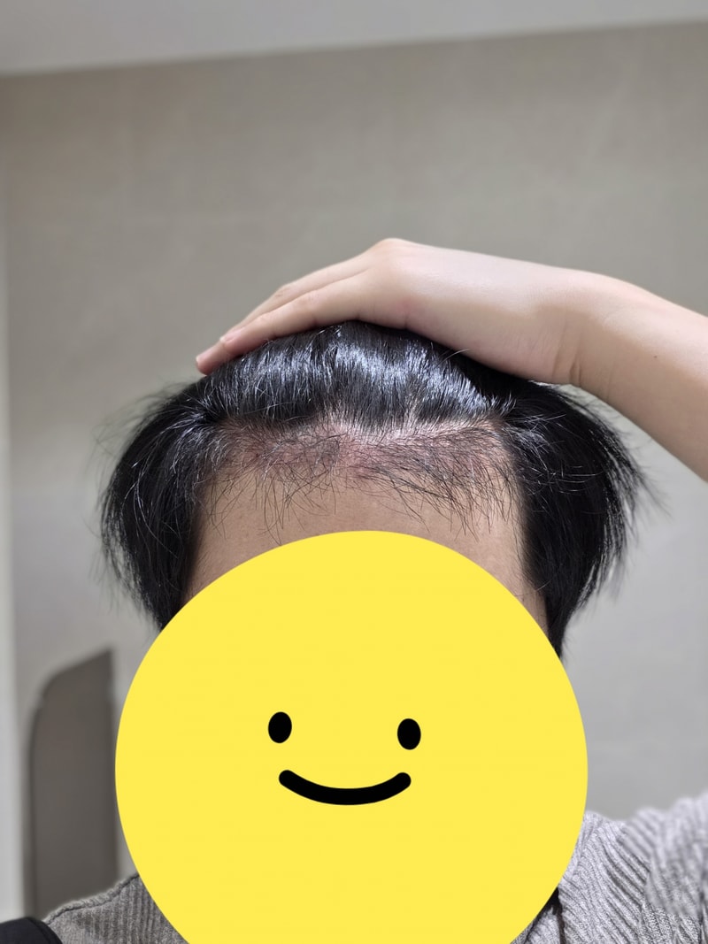 뉴헤어 3개월차 비절개 모발이식 후기 입니다(1600모낭)