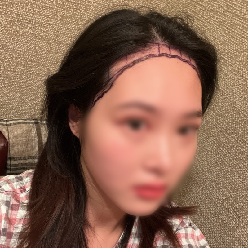 1600모낭 절개 모발이식 11개월차