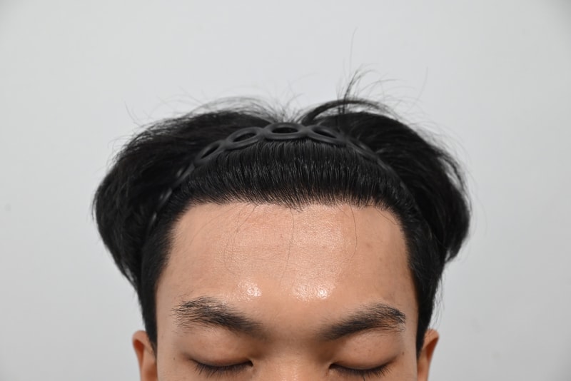 심고 나니 왜 이제야 했나 싶습니다…모발이식 후 9개월차 후기