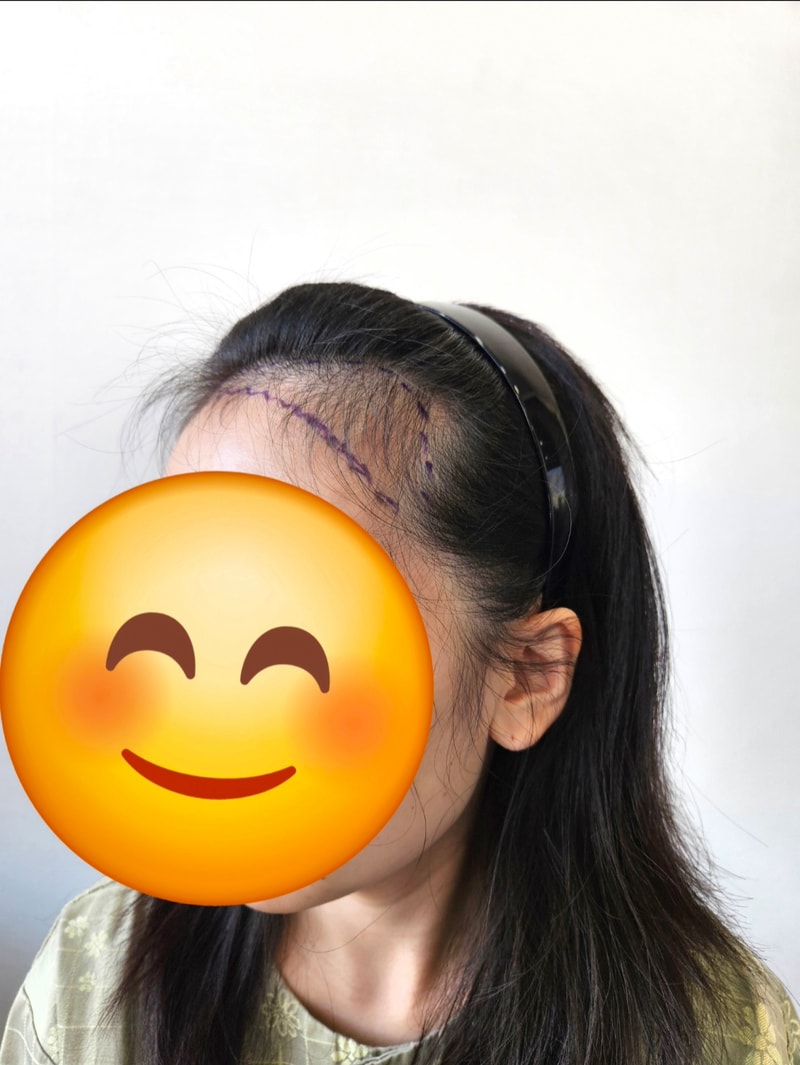 모재성 헤어라인 시술 후기