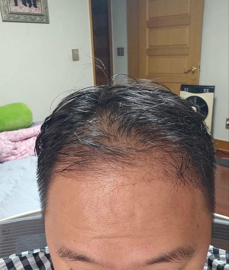 모발이식 실패 후 재수술 1주 후기. (압구정 맘모스헤어라인 1014모낭 3차 재수술, 비절개)