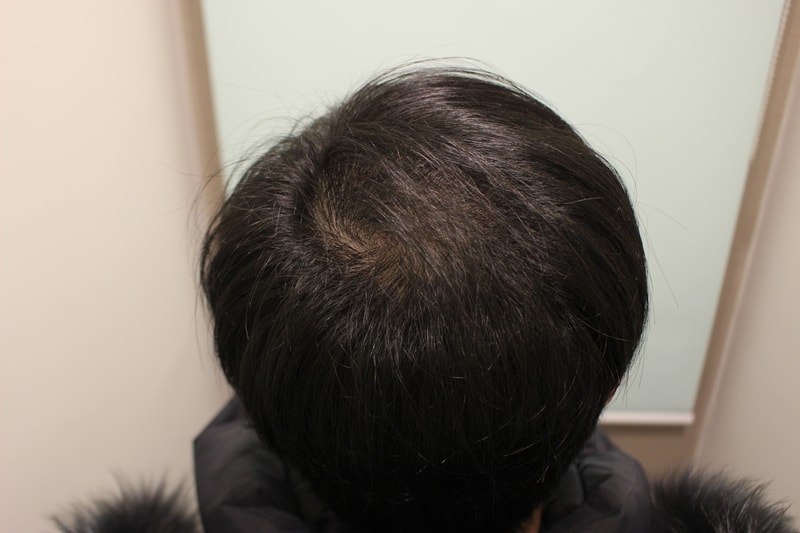 수술후 6개월 5.JPG