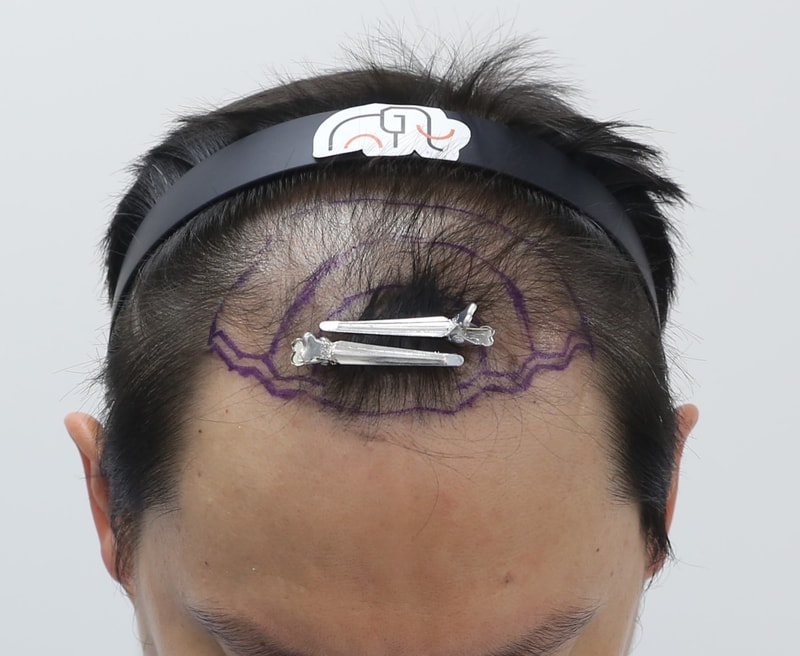 압구정 맘모스 확산성탈모 대량 모발이식 4개월 후기입니다. 남다우원장님 경과 확인마쳤습니다.