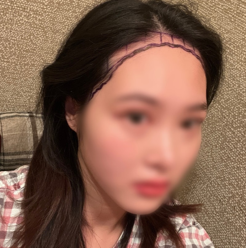 [뉴헤어] 1600모낭 절개 1년차 후기
