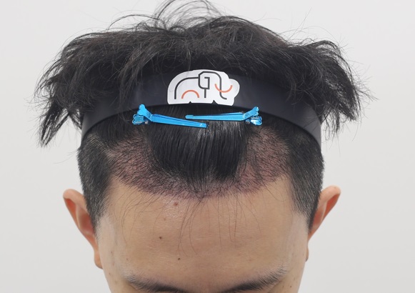 압구정 맘모스헤어라인의원 비절개 모발이식 2주 ~ 3개월차(암흑기) 후기
