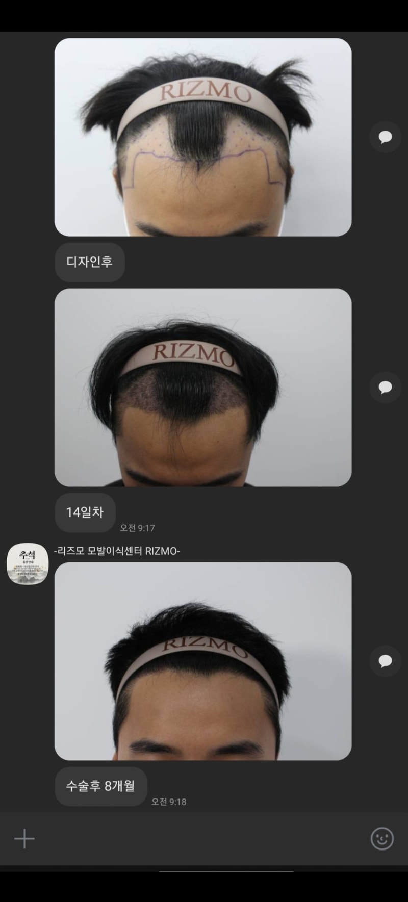 리즈모의원 8개월 후기 입니다.