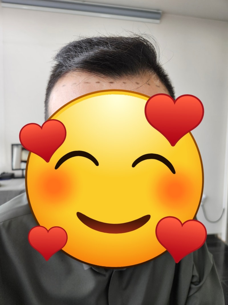모재성성형외과 비절재 3500모낭(7000모) 8개월차 후기