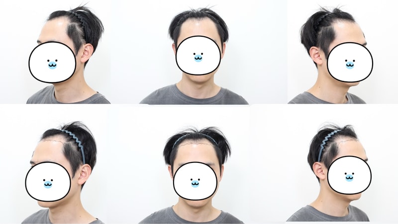 모발이식 3600모 절개 10일차