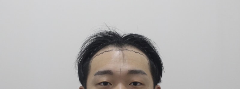 ★モプロ医院★ ヘアライン 植毛 非切開 4200毛 14日経過