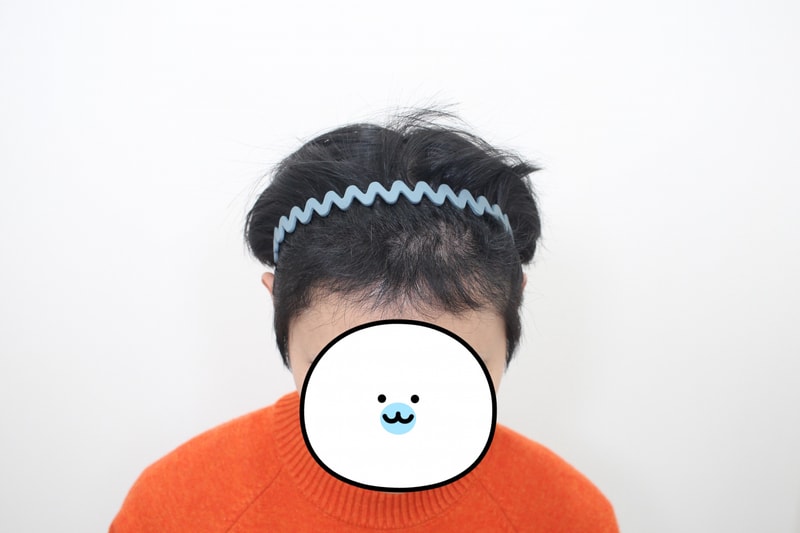 신사역, ★모프로의원 문건학 원장님, 절개 모발이식 3600모 6개월 경과