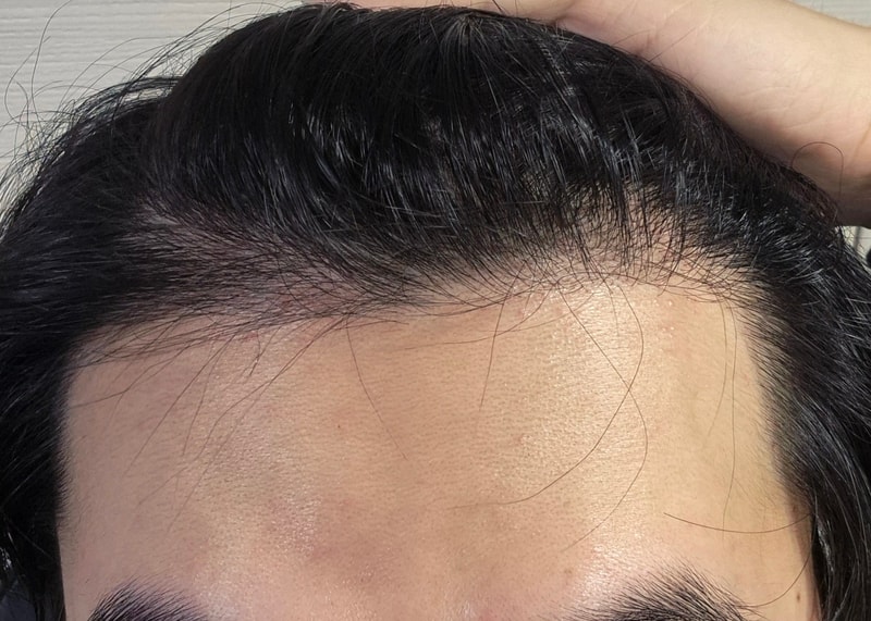 Review of non-excisional 3,200 Mo 8 Months of Surgery