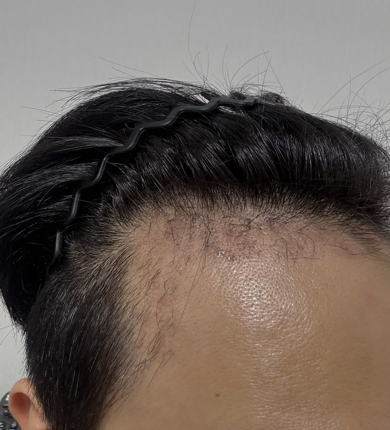 대구헤어로의원 비절개 3000모 암흑기