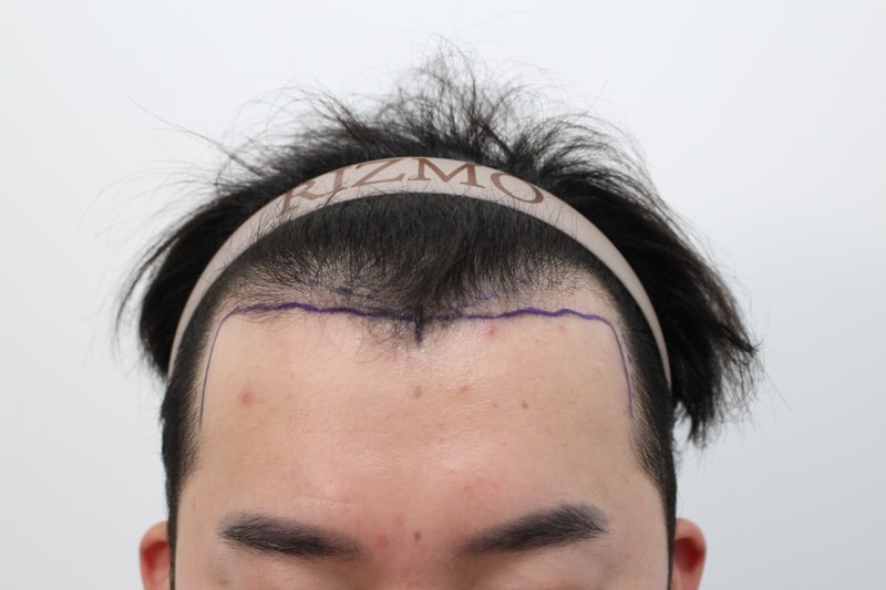 안녕하세요 비절개 모발이식 한지 1년째가 다되서 글올립니다.