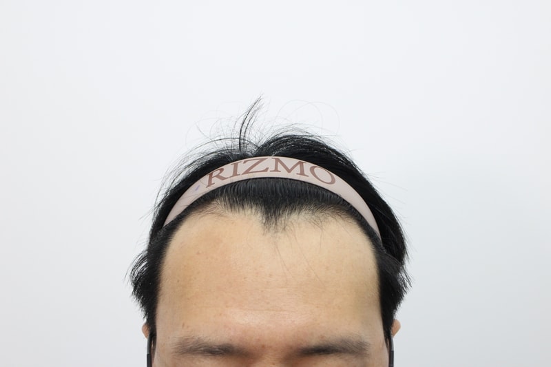 The 2nd week of hair transplantation at Lizmo Clinic in Busan