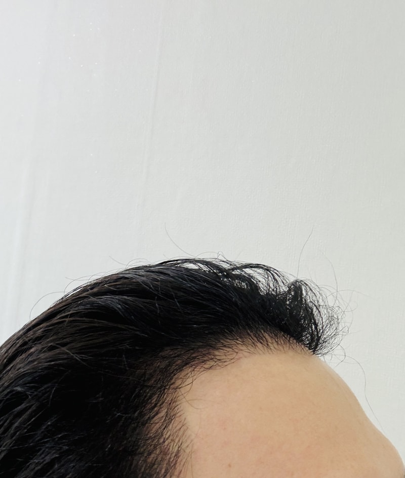 모발이식 7개월차