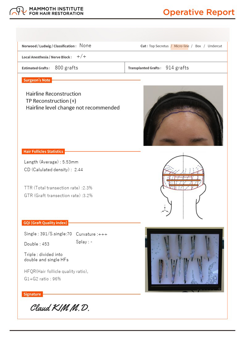 부산 비절개슬릿 여성헤어라인 교정(맘모스헤어라인)