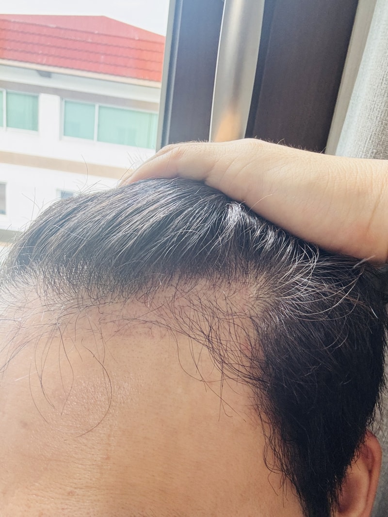 모발이식 3개월 후기