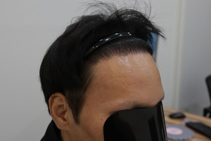 광주압구정모비앙 모발이식 1년경과후기