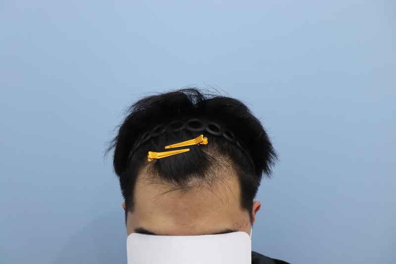 광주 압구정 모비앙의원 경과 후기