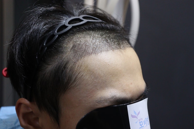 Review of the 10th day of hair transplantation at Mobiang Clinic in Apgujeong, Gwangju