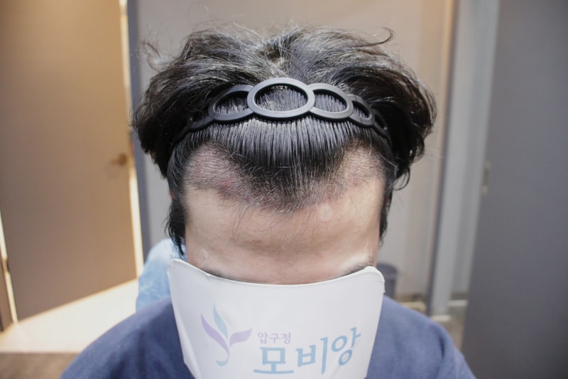 광주 압구정 모비앙 의원 2주 경과 후기