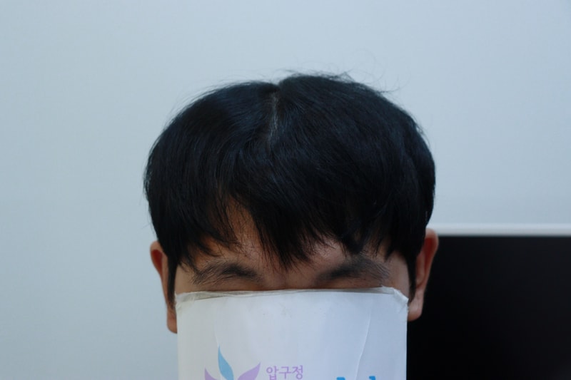 광주 압구정 모비앙의원 모발이식 1년경과후기