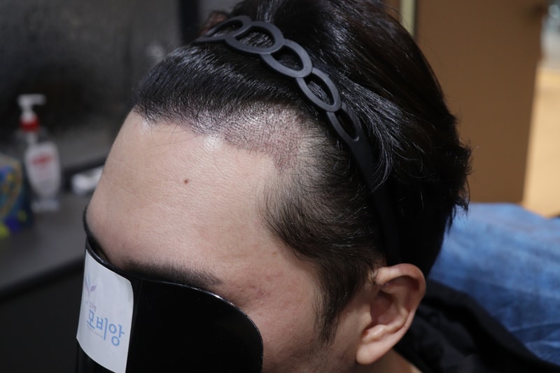광주 압구정 모비앙 의원 모발이식 2주 경과 후기