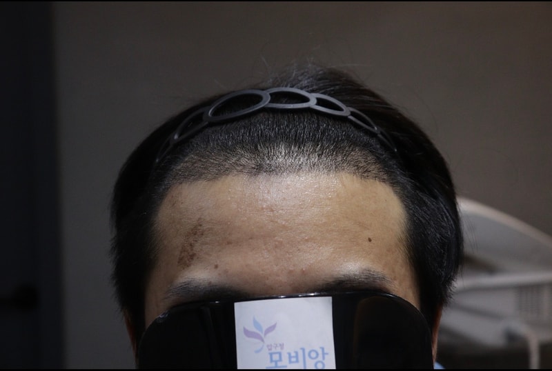 光州光州狎鴎亭モビアンクリニック 植毛2週間経過体験談