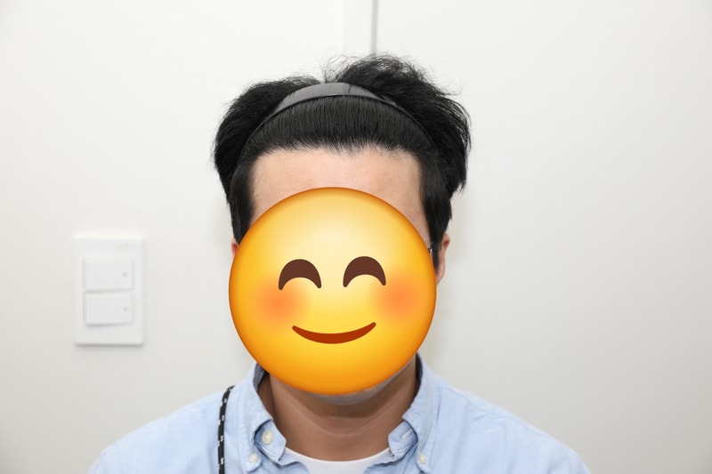 뉴헤어성형외과 모발이식 1년후기