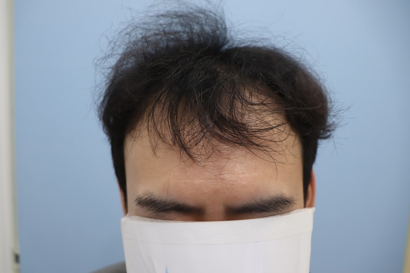 광주 압구정 모비앙의원 모발이식 1년경과 후기