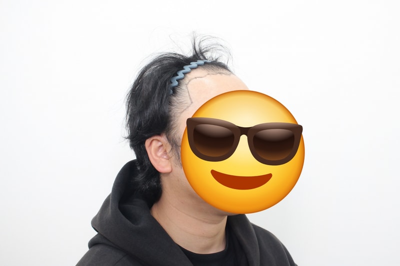 (모프로의원) 5109모 모발이식후기