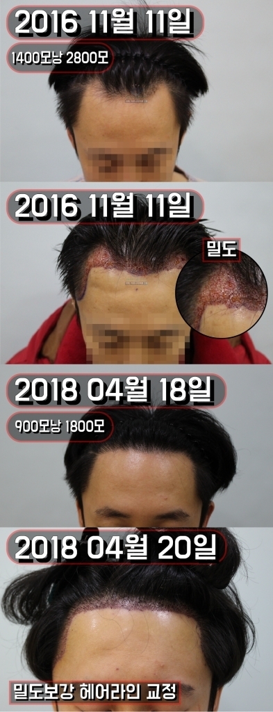 헤어라인교정_대지 1.png