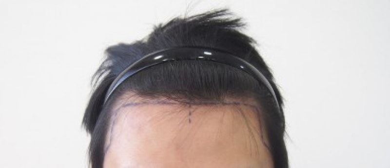 수술 5개월,, 뒤늦은 후기..! 1025 모낭 비절개