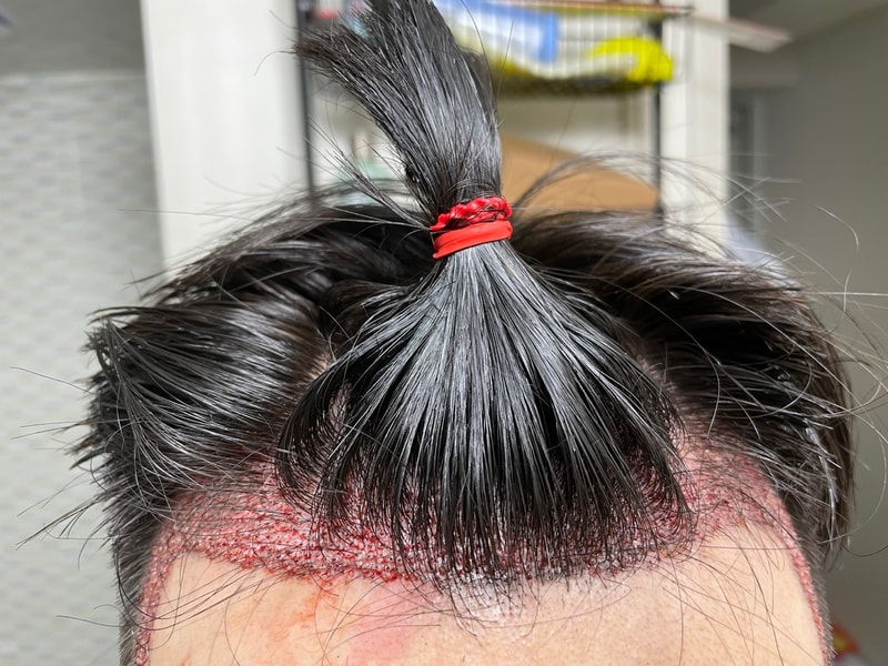 이식후3.jpg