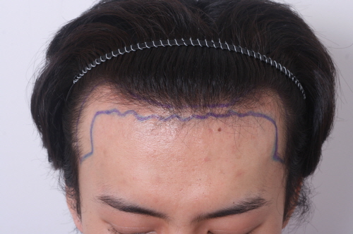 수술전디자인 (1).jpg