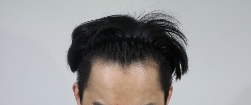 수술전 머리상태.jpg