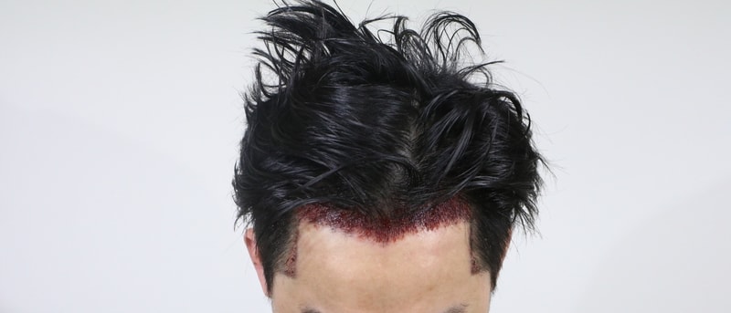 수술직후 머리상태.jpg