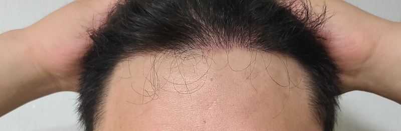 모재성 남성 M2형 탈모 이식후기 1450모낭. 8개월 후기.