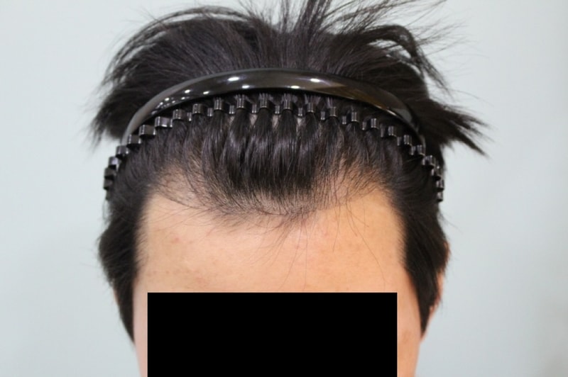 크기변환_크기변환_수술전 (7).JPG
