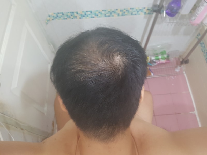 수술후-5개월후.jpg