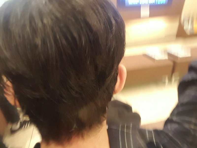 수술후 뒷모습.jpg