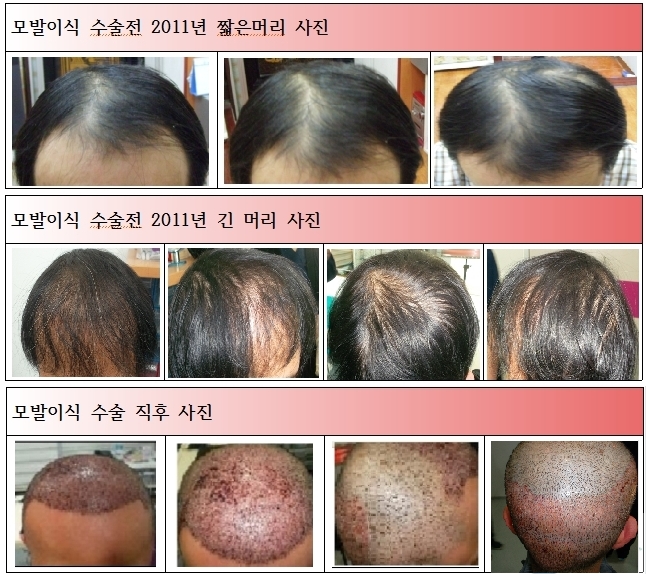 수술 전.후 통합사진.JPG