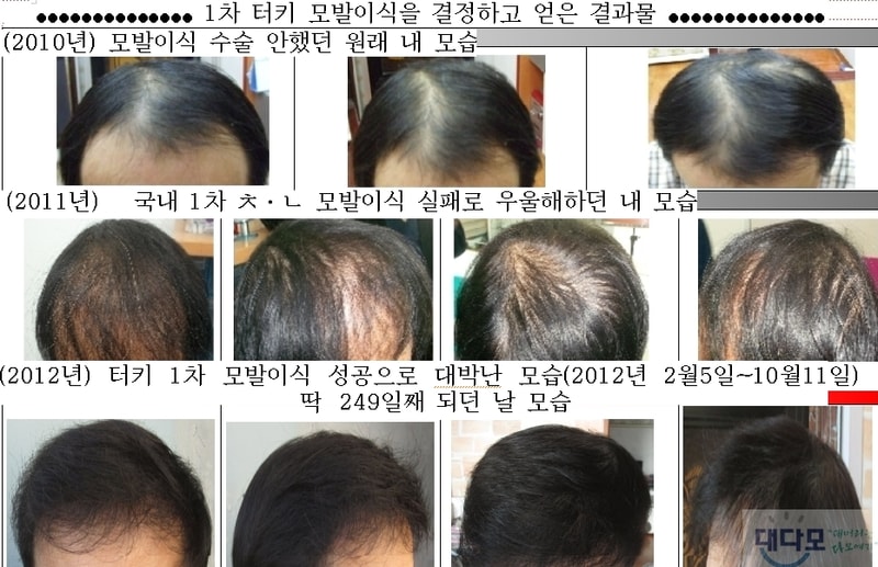 1,2차 수술 통합사진.JPG