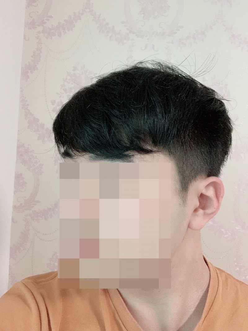[모발이식1년후기]
