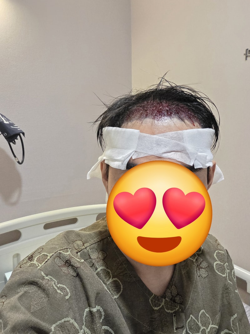It's the first day of M-shaped incision