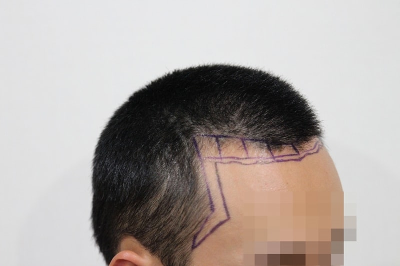 수술전 2.jpg