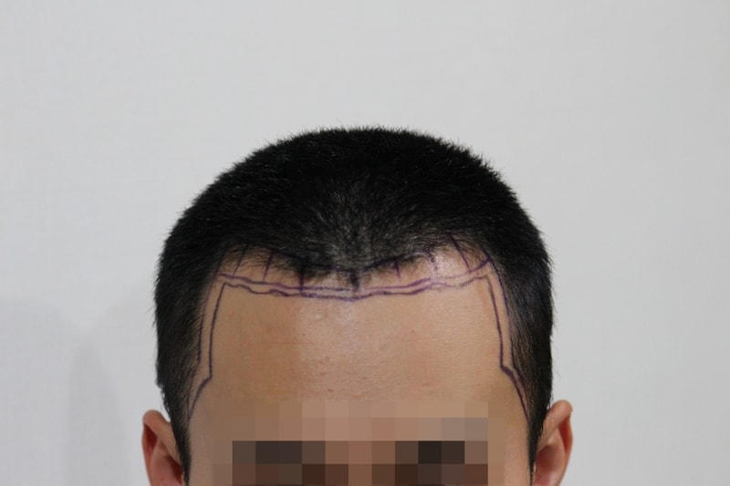 뉴헤어 1600모낭 비절개 삭발 슬릿 12개월차 후기 및 평가 입니다.