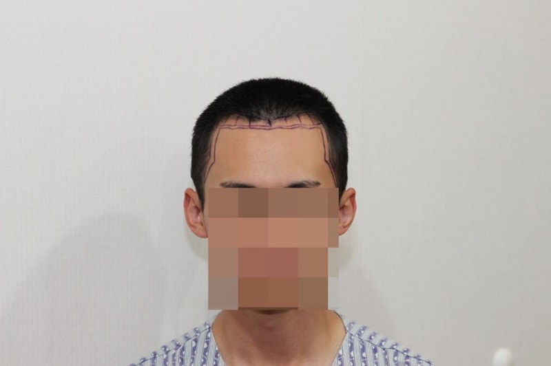 뉴헤어 1600모낭 비절개 삭발 슬릿 6개월차 후기 및 평가 입니다.
