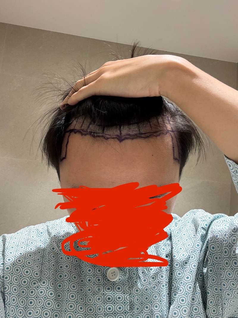 비절개 1600모낭 모발이식 후기 입니다